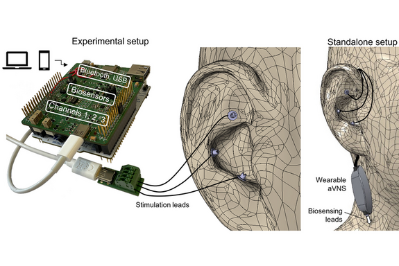 Individualised auricular vagus nerve stimulation at the right time and with the right strength.
